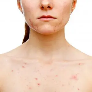 Chapter 8 - Spray tan contraindications and complications - shutterstock 124532092 acne on chest uai